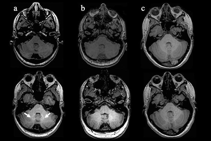 Study Addresses Use of GBCAs in Multiple Sclerosis Patients Image